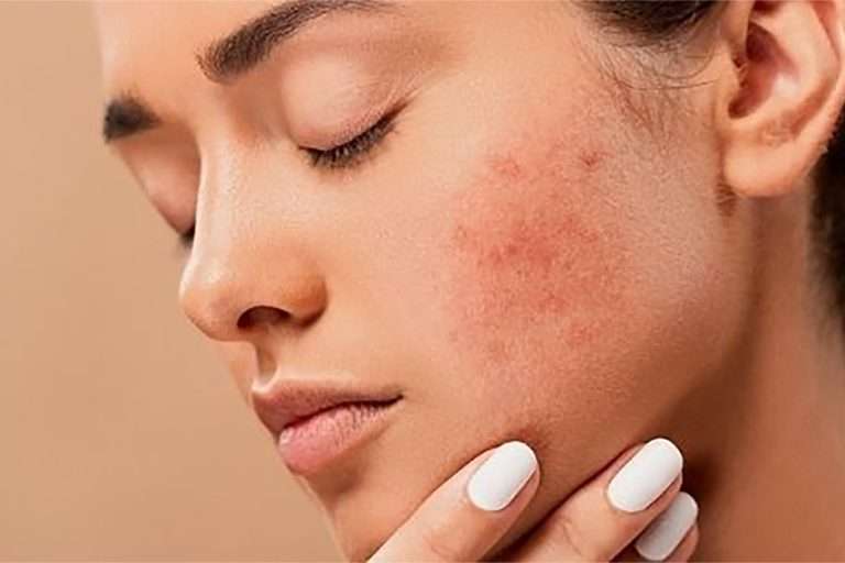 Etats inflammatoires