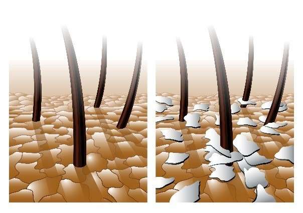 pellicules grasses