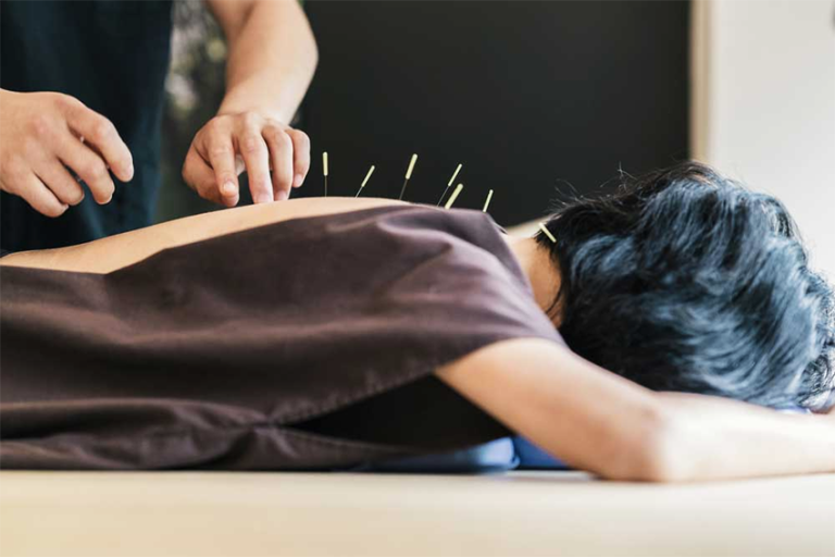 ACUPUNCTURE