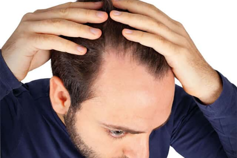 Chute de cheveux